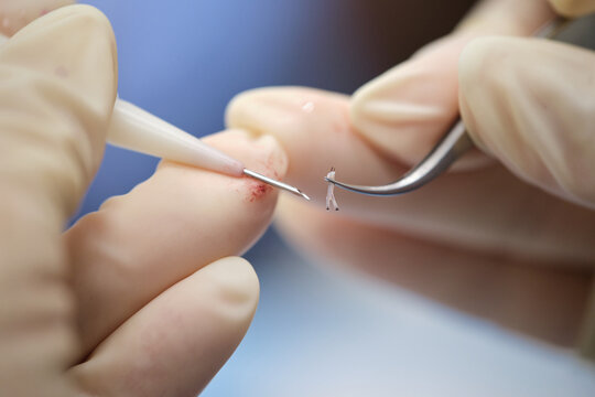 Hair graft being loaded into a Choi implanter pen