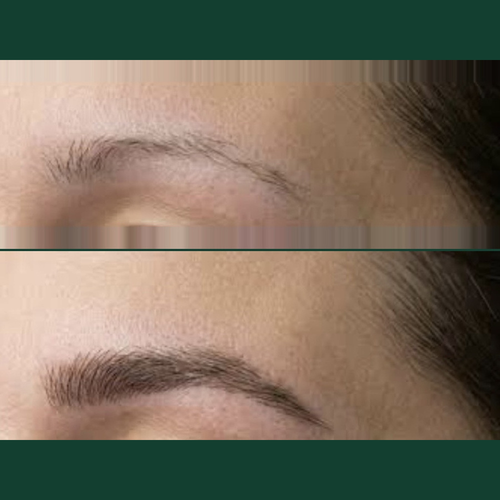 Eyebrow restoration before-and-after reference image