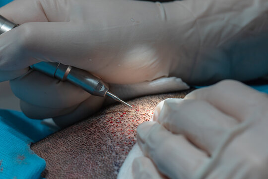 FUE hair transplant procedure on the scalp